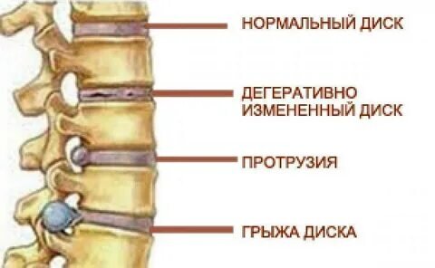 Изображение взято в Яндекс картинках. Но на самом деле так не бывает. При грыжах и протрузиях позвонки никогда не располагаются ровно. Всегда будет локальное или системное искривление позвоночника.