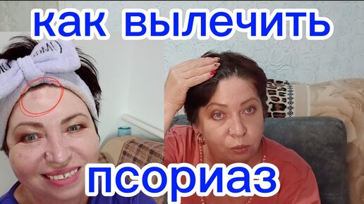 Я как умная Маша решила выйти в ПРЯМОЙ Эфир...Ютуб НЕ ПУСТИЛ)))Как я Вылечила ПСОРИАЗ за МЕСЯЦ ...Долгожданная РЕМИССИЯ!