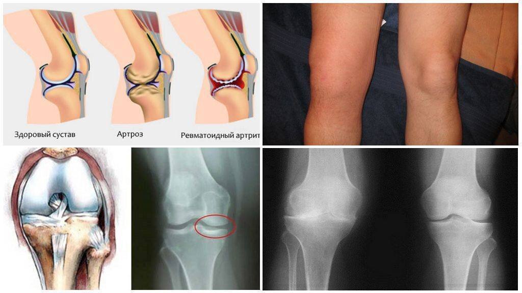 Артроз коленного сустава картинки