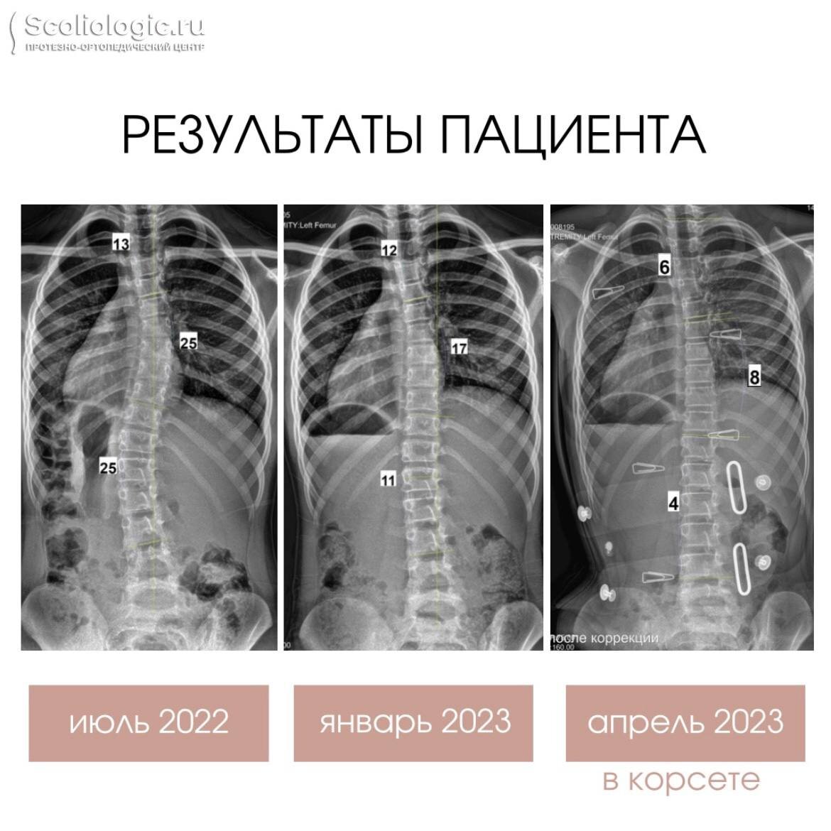 Матрас при сколиозе 1 степени