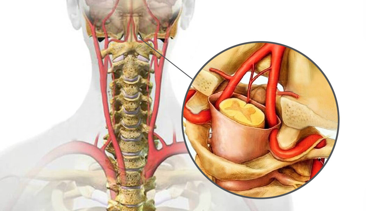 Дорсопатия остеохондроз. Синдром позвоночной артерии при шейном остеохондрозе. АВМ позвоночной артерии. Ход позвоночной артерии в шейном отделе позвоночника. Позвоночные артерии в шейном отделе.
