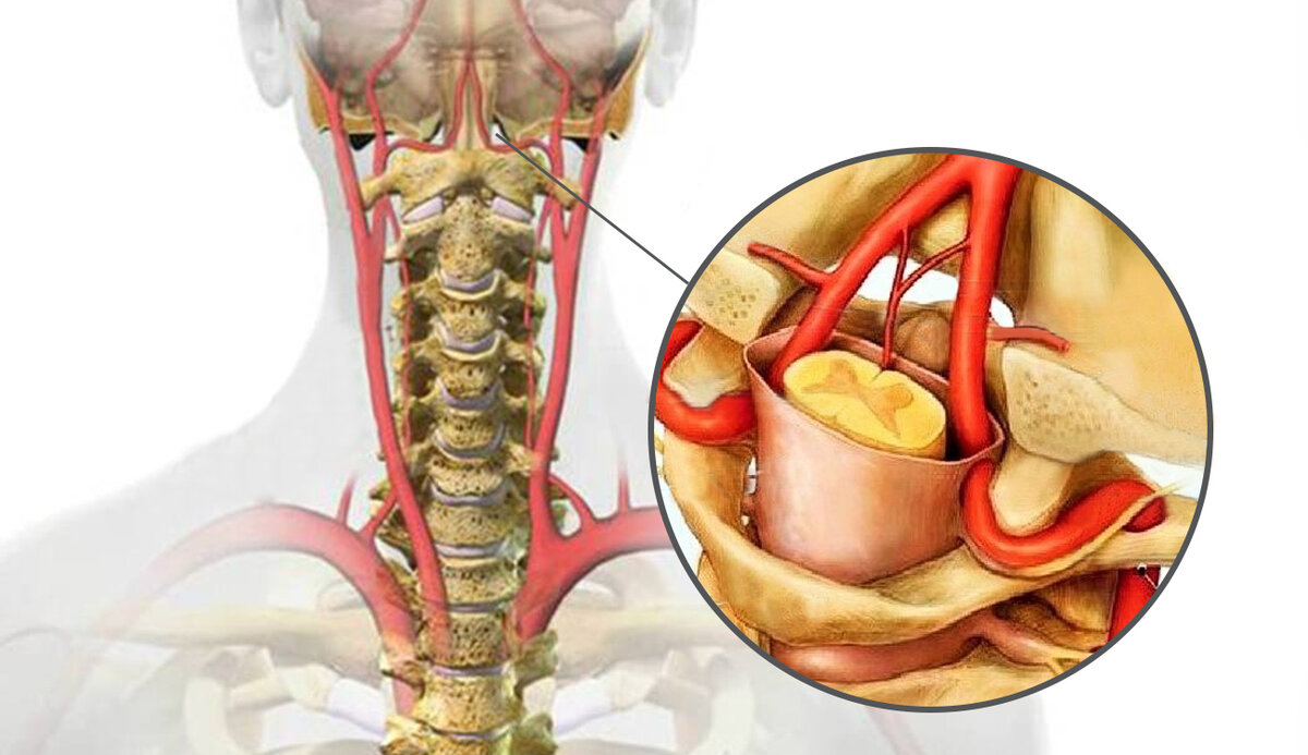 Шейный остеохондроз и артериальное давление: есть ли связь | Здоровье с  B.Well | Дзен