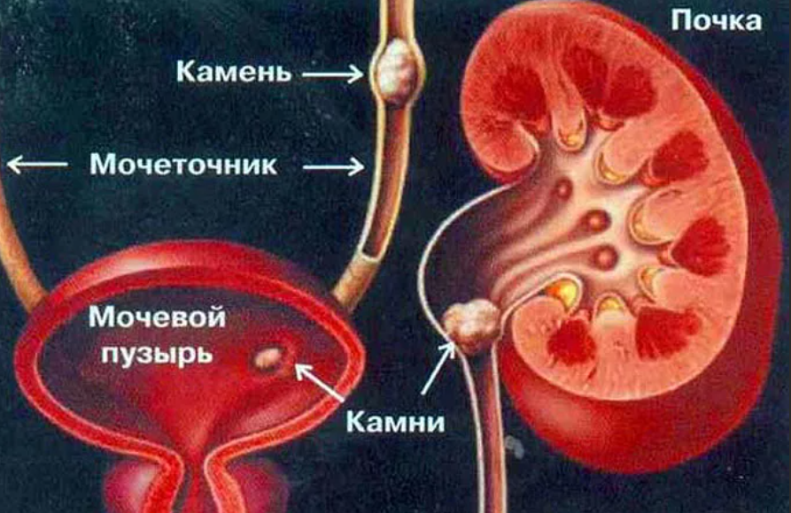 обструкция протоков мочеточников и обструкция желчных протоков, обтурация протоков и мочекаменная болезнь из-за кальцификатов и оксалатов
