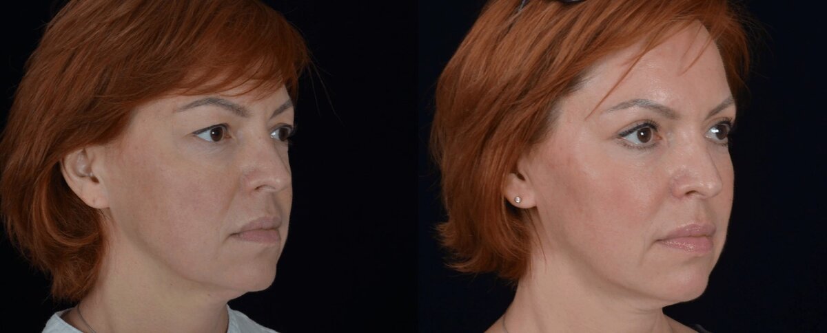 Липофилинг лица и пластика верхних век фото до и после. Фото с сайта хирурга Д.Р.Гришкяна. Имеются противопоказания, требуется консультация специалиста