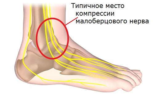 Повреждение поверхностного малоберцового нерва. Нейропатия малоберцового нерва. Неврит малоберцового нерва. Синдроме компрессии общего малоберцового нерва.