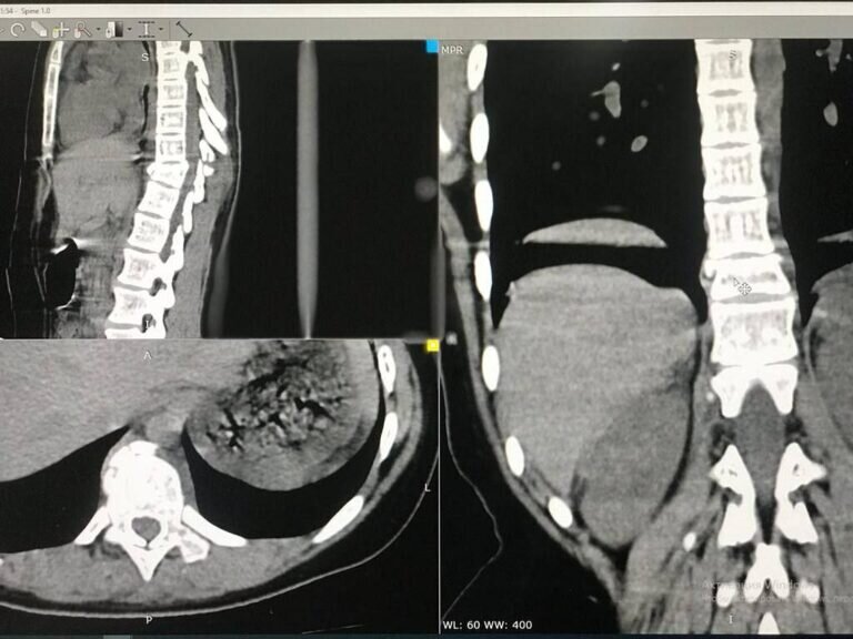    Оренбургские хирурги провели уникальную операцию на позвоночнике подростка Кристина Просвиркина