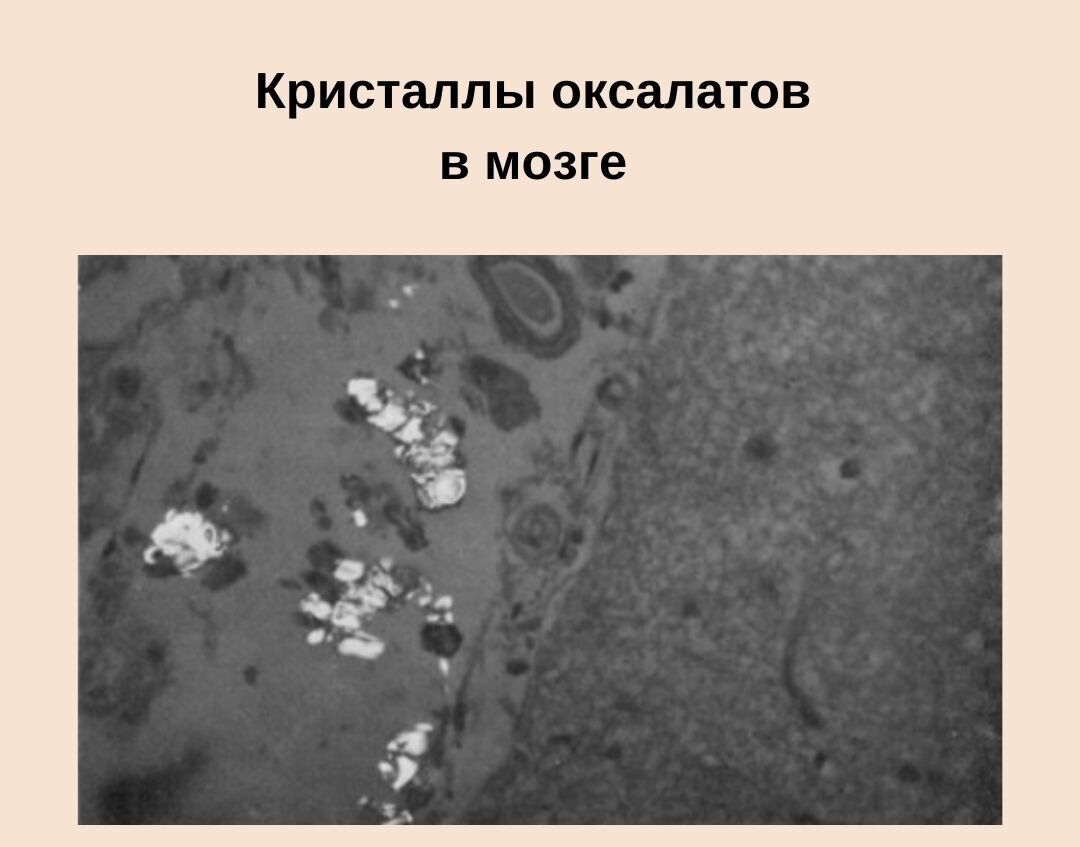 Оксалаты кальция в моче норма. Оксалаты в моче. Оксалаты в моче фото. Кристаллы оксалата. Оксалат кальция моногидрат.