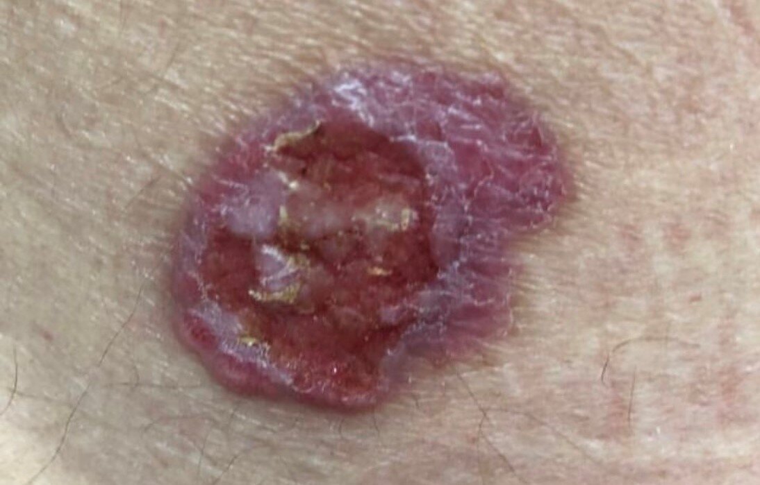 Базалиома (базальноклеточный рак)