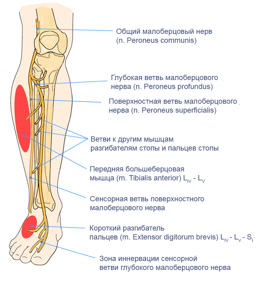 Невропатия (неврит) малоберцового нерва. Нейропатия малоберцового нерва. Нейропатия большеберцового нерва. Седалищный и малоберцовый нерв.