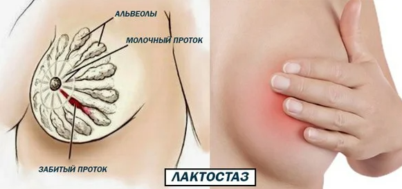 Что делать, если молоко застоялось в грудных железах