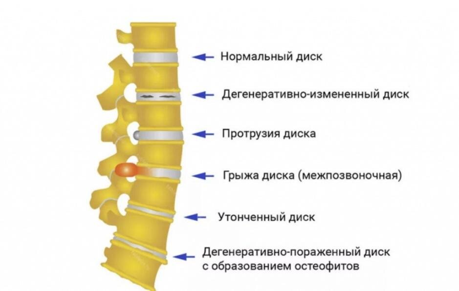 Протрузия грудного отдела | Первая Медицинская Клиника | Дзен