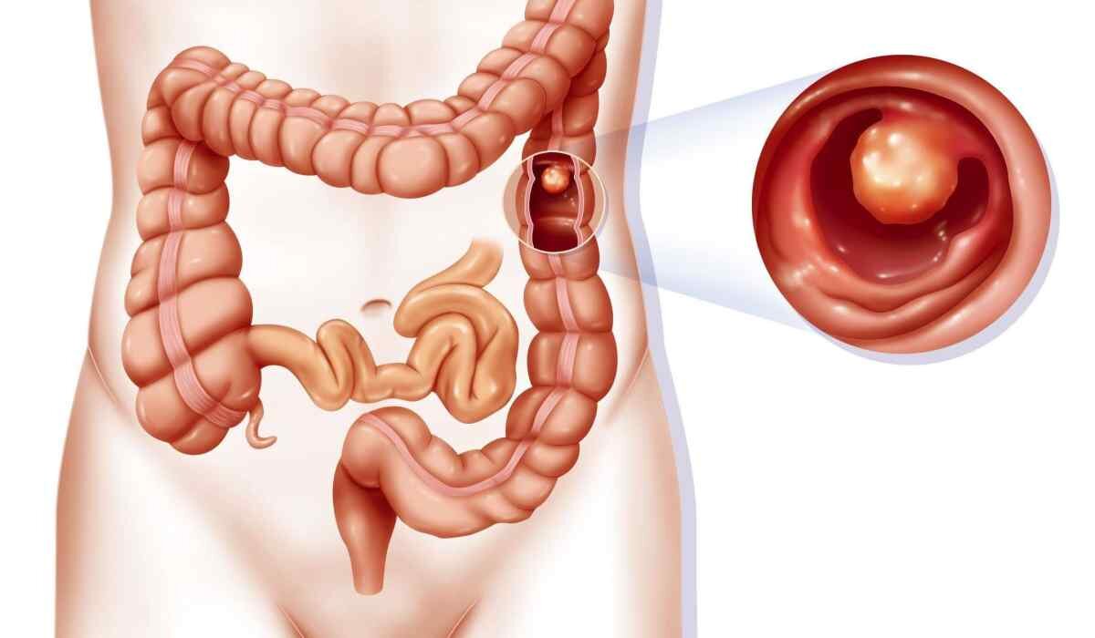 Полипы в кишечнике