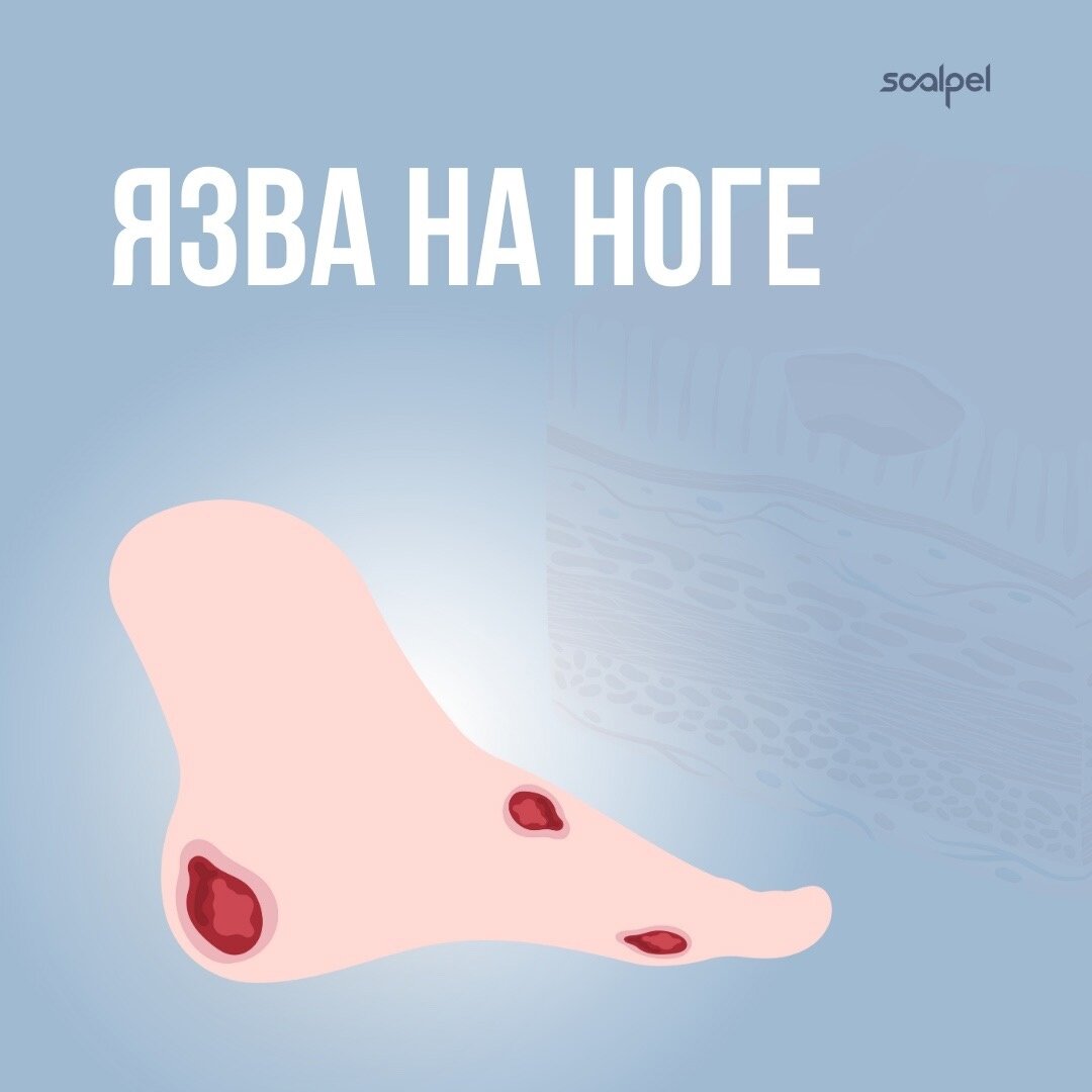 Язва на ноге