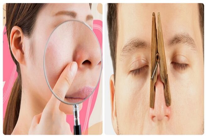 Искривление носовой перегородки: причины и методы лечения