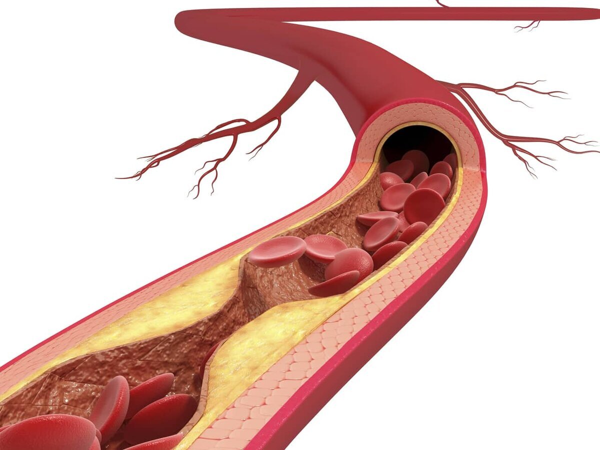 Фото бляшки сосудов. Атеросклероз холестериновая бляшка. Атеросклероз это стенки артерии. Атеросклероз (закупорка кровеносных сосудов). Атеросклеротическое поражение кровеносных сосудов.