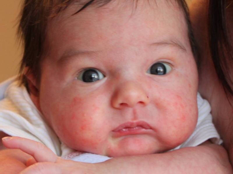 13 сыпей новорожденных и младенцев: что норма, а что нет