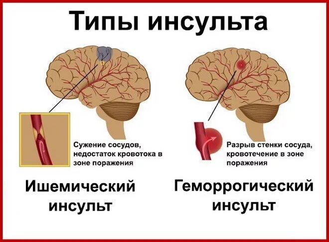 Передается ли инсульт по наследству