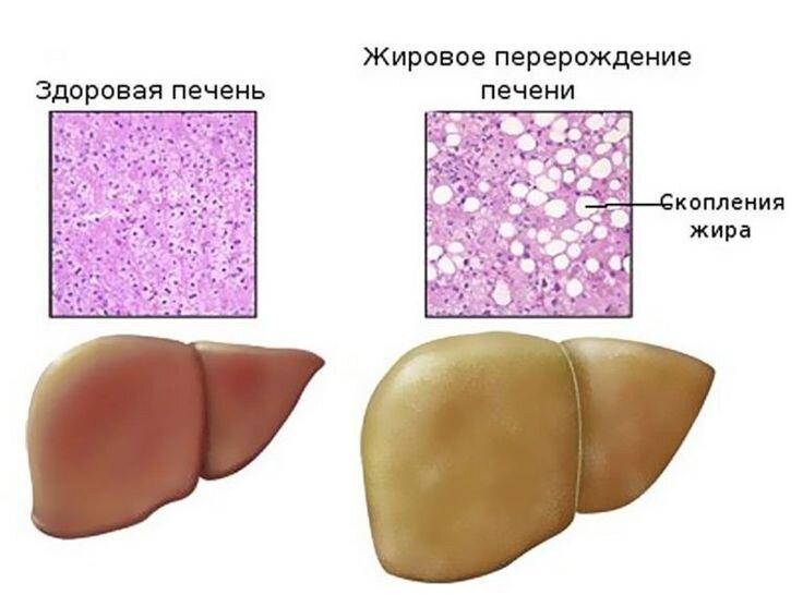 Как избавиться от целлюлита в домашних условиях: проверенные способы