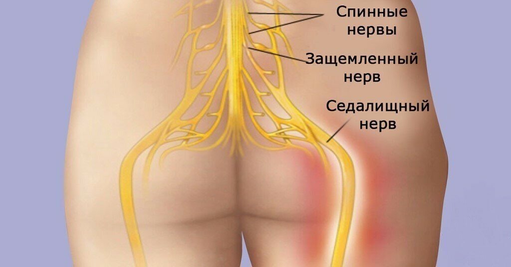 Как проходит седалищный нерв у человека по телу фото