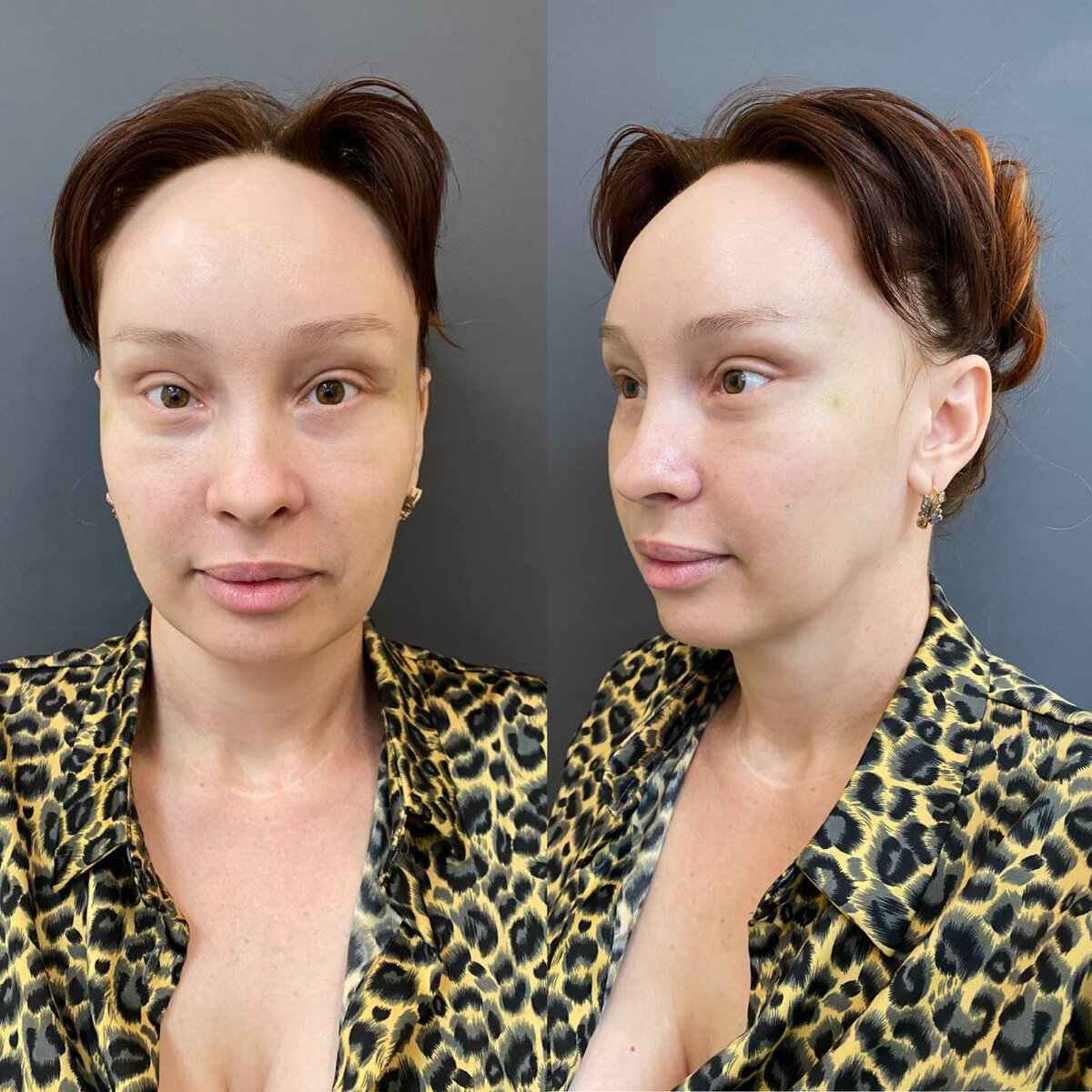 Промежуточные результаты во время реабилитационного периода 