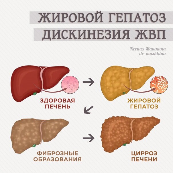 Гепатоз печени симптомы и лечение. Жировой гепатоз печени. Гепатоз ожирение печени. Жировой гепатоз печени фото. Печень при жировом гепатозе.