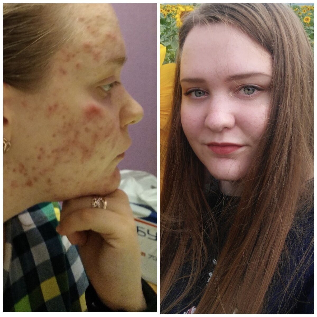 До после моей кожи, разница где-то 6 месяцев 