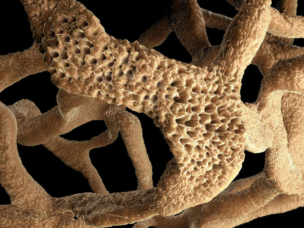 Остеопороз. Фото из открытых источников.