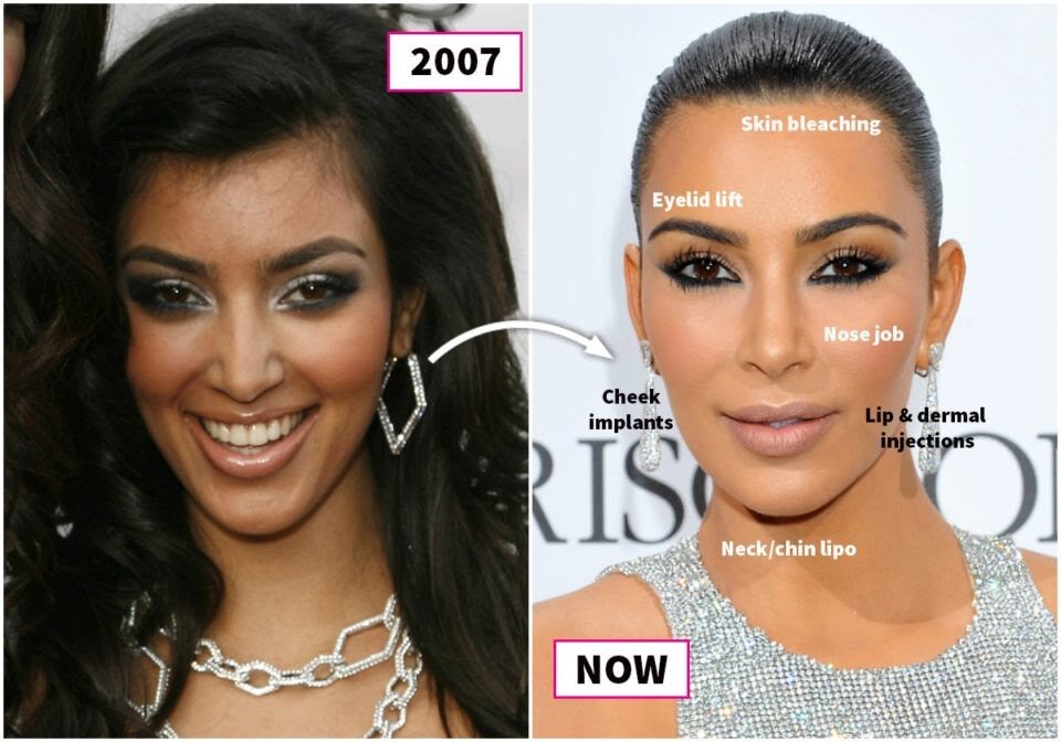 Звезды до и после пластики: от Ким Кардашьян до Меган Фокс