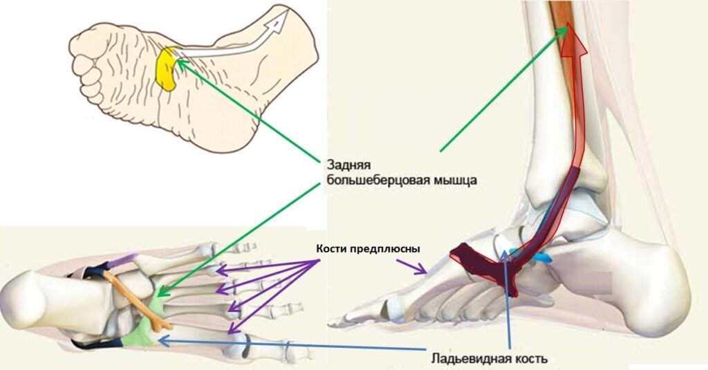 Плоскостопие. Профилактика плоскостопия