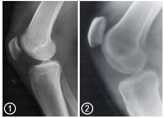 Расположение надколенника при нормальном функциональном состоянии (1) и при Patella Alta (2)