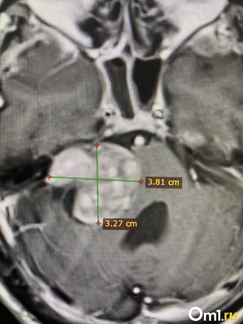 Рак ствола головного мозга. Псевдоопухоль головного мозга. Опухоль ствола головного мозга Морозовская больница. Арахноэнцефалит головного мозга.