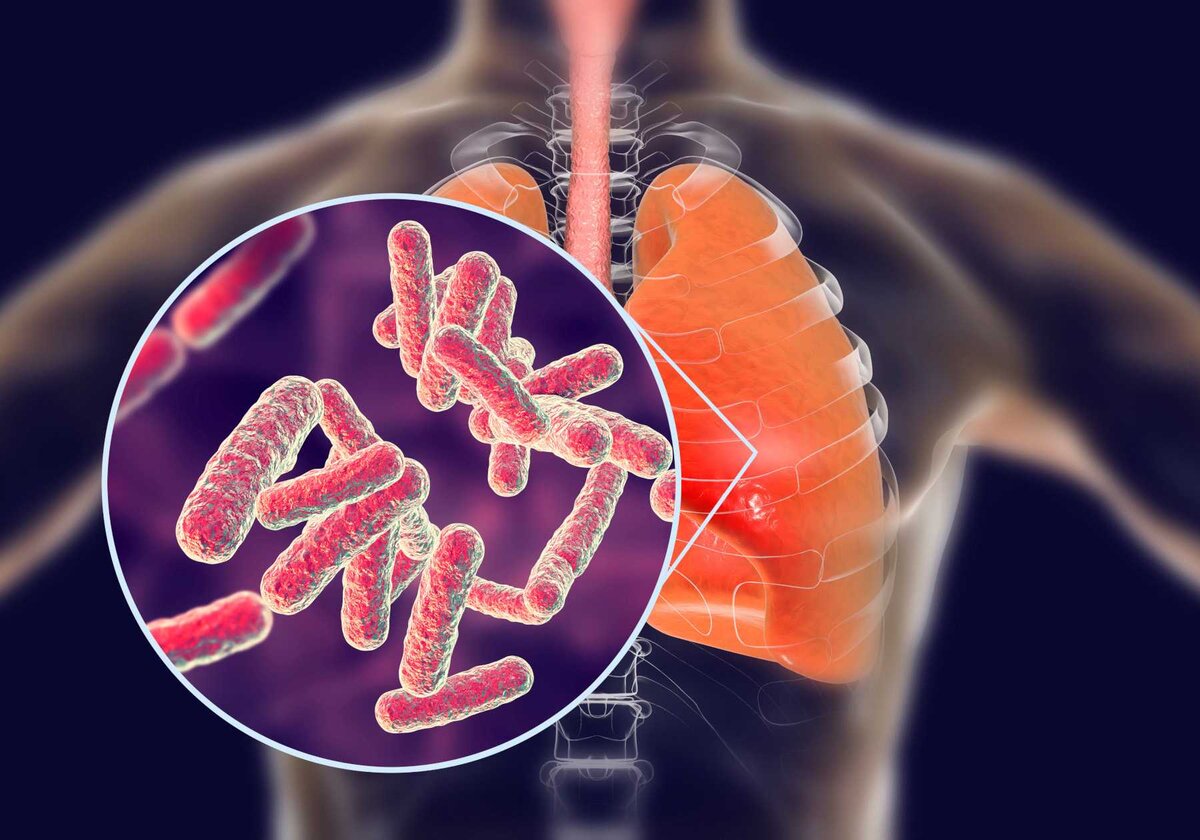 "Излечение туберкулеза Природными антибиотиками"