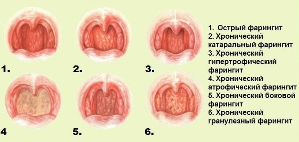 Фарингит у взрослых: причины, симптомы, лечение