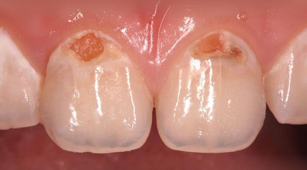 Случай из практики: пришеечный кариес у подростка | Записки Честного ...