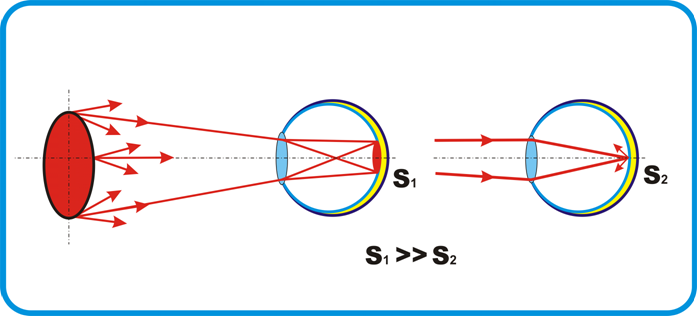 Если изображение фокусируется перед сетчаткой глаза то возникает