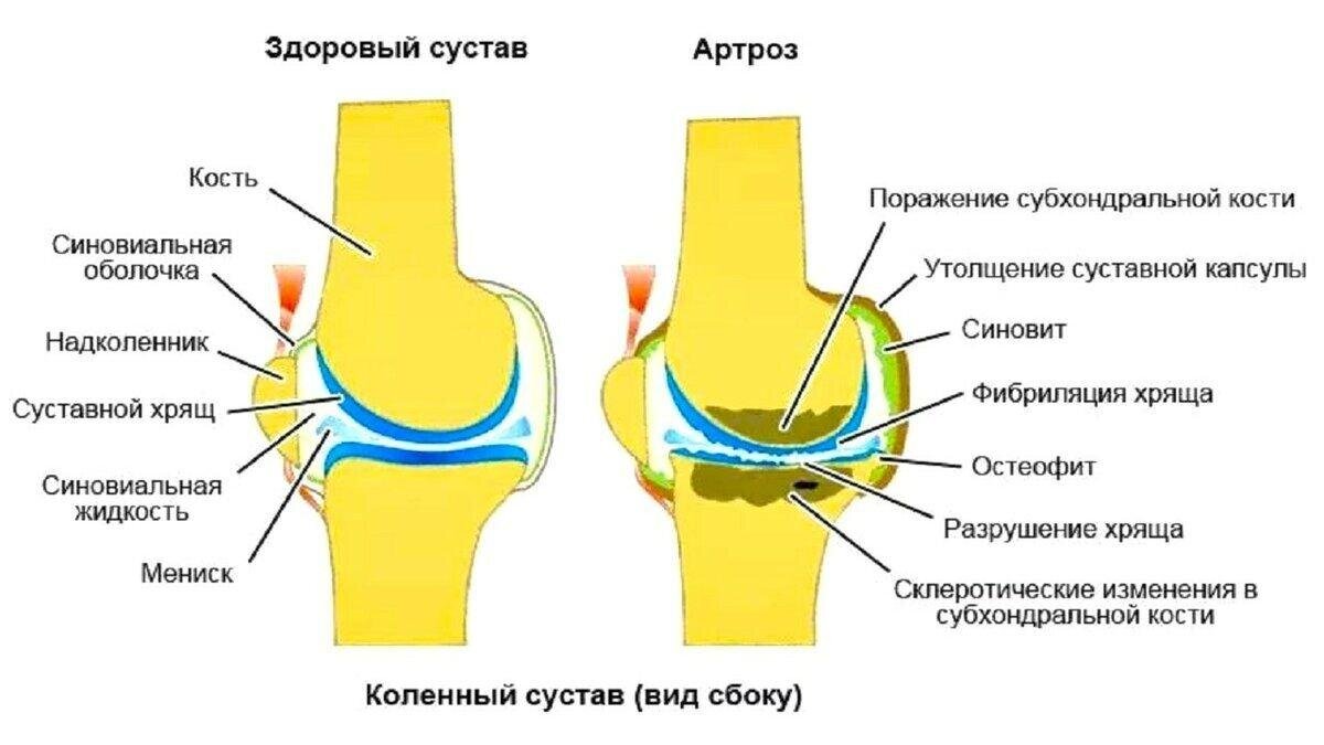 Коленный сустав анатомия артроз