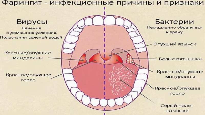 Фарингит у детей препараты