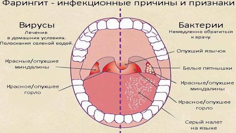 Фарингит лечение