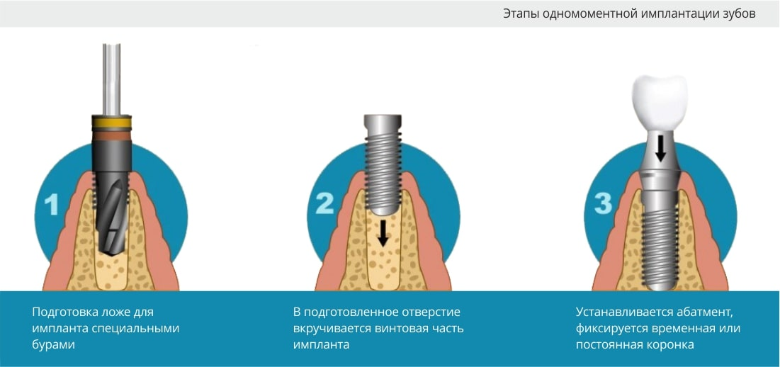 Когда можно вставлять имплант. Этапы одномоментной имплантации зуба. Этапы установки импланта зуба одномоментное. Одномоментная имплантация зубов этапы. Имплантация зубов схема.