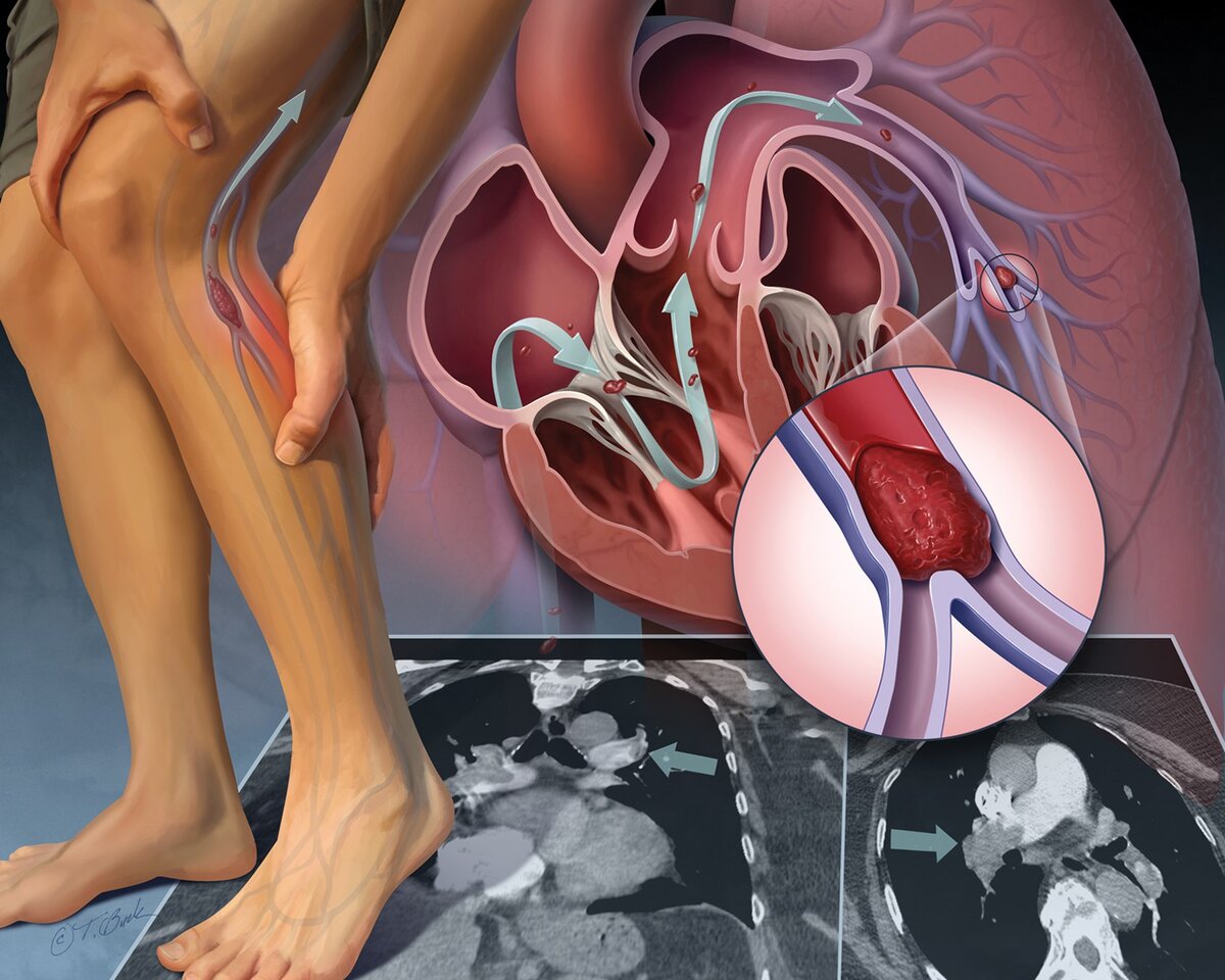 Тромбы в сосудах — почему это смертельно опасная болезнь?