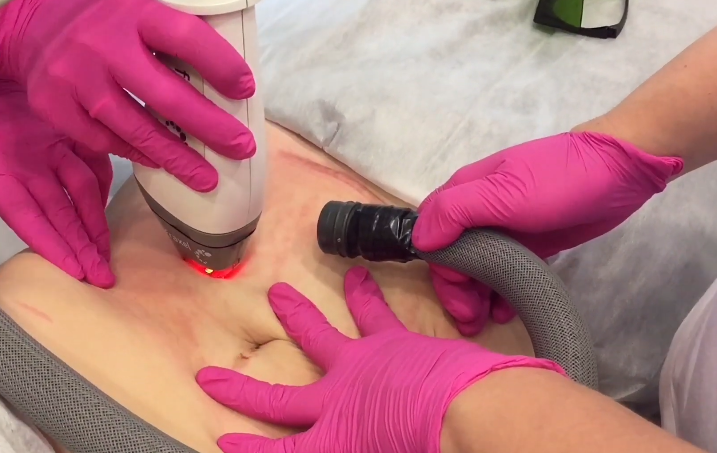 Удаление растяжек на животе с помощью аппарата Fraxel 