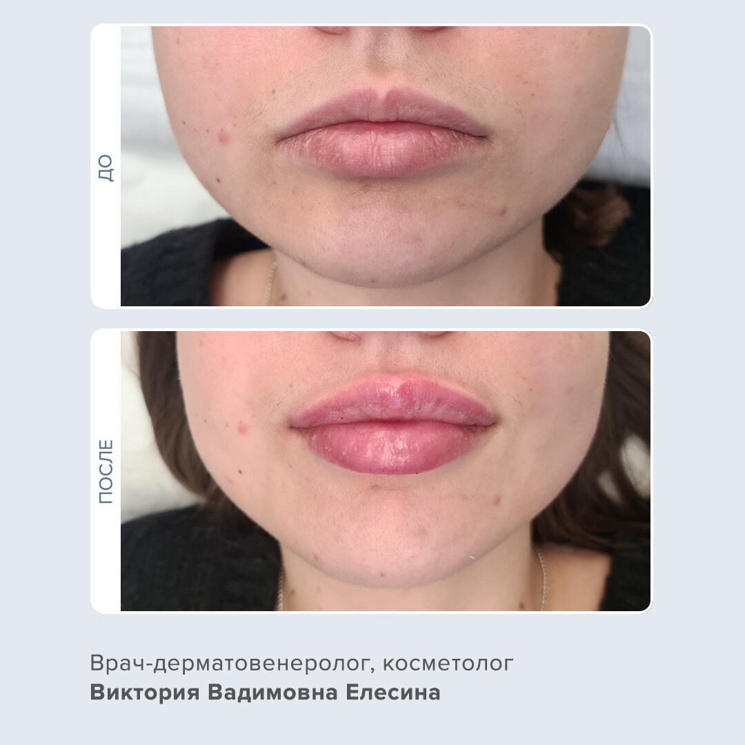 Фото БОТОКС В УГОЛКИ ГУБ