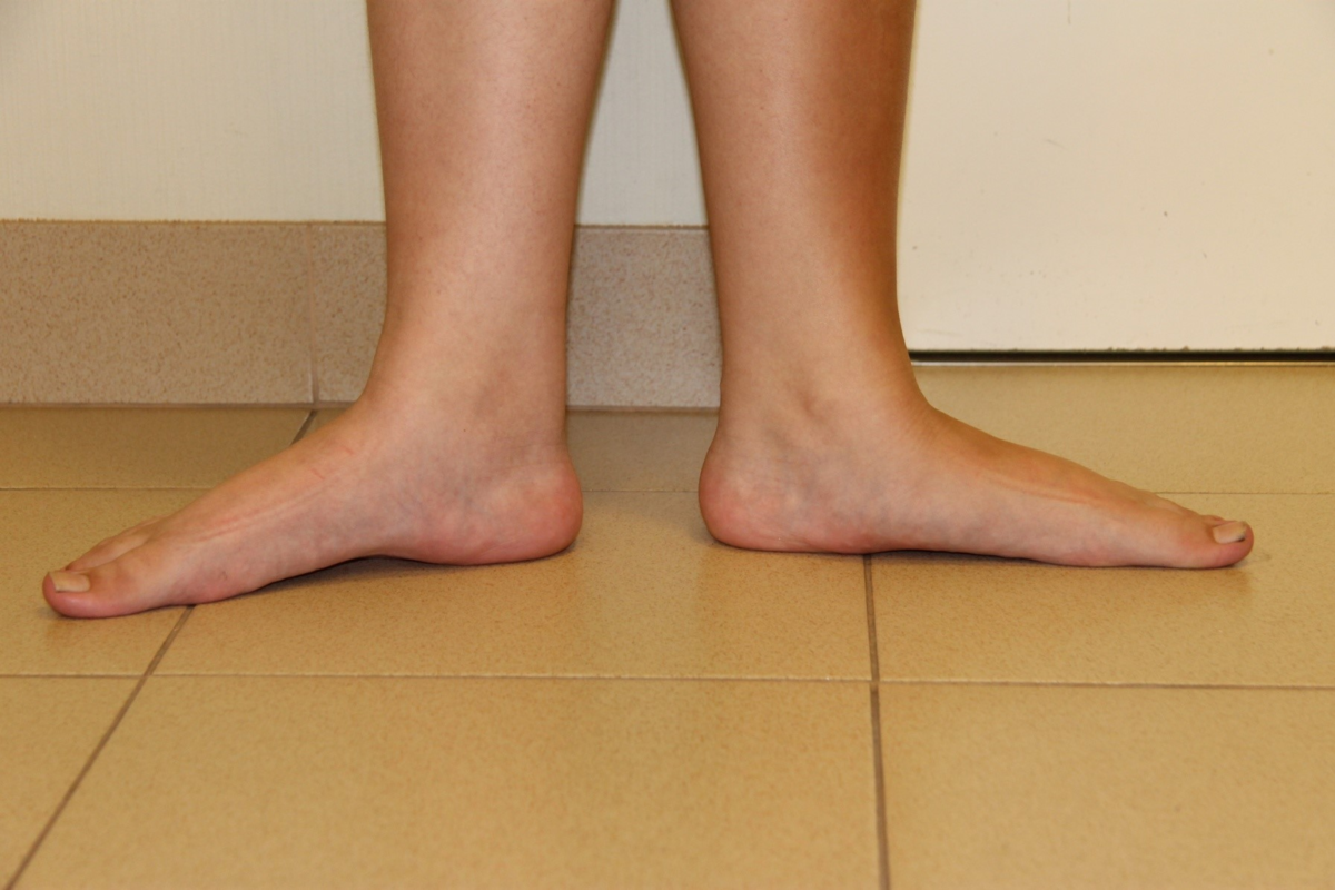 What is the Calcaneus? (with pictures)