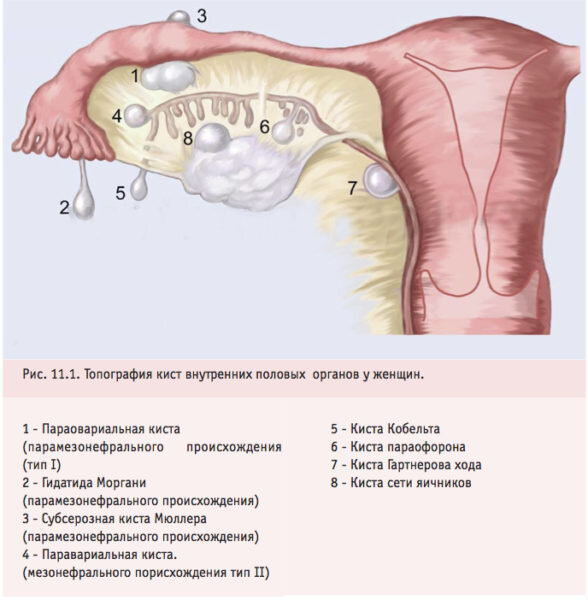 Типография кист женских половых органов