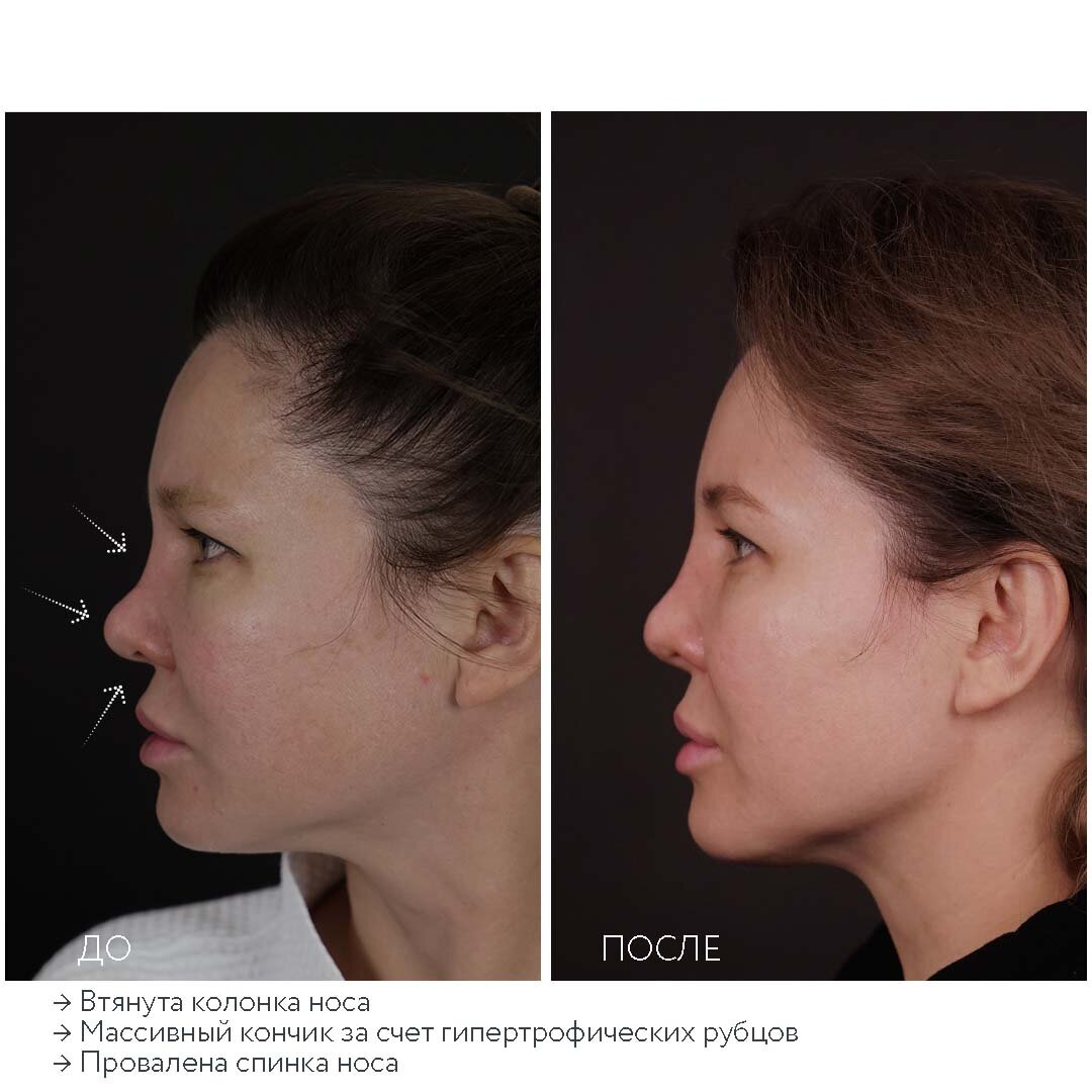 У пациентки в результате проведенной в сторонней клинике риносептопластики были деформированы арки носа, спинка слишком занижена, колумелла (наружная часть носовой перегородки между ноздрями) втянута. Я провел реконструктивную риносептопластику с целью придать носу привлекательную форму