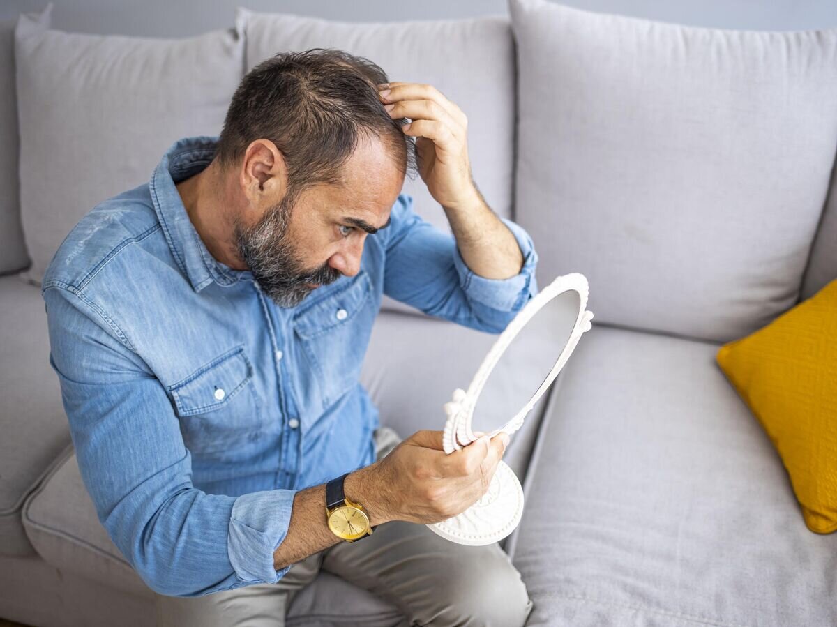    Алопеция у мужчины© iStock.com / dragana991