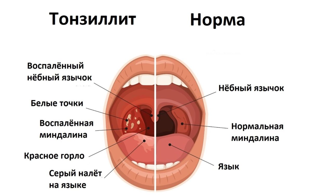 Что делать если появилось белое пятно на языке - причины и лечение