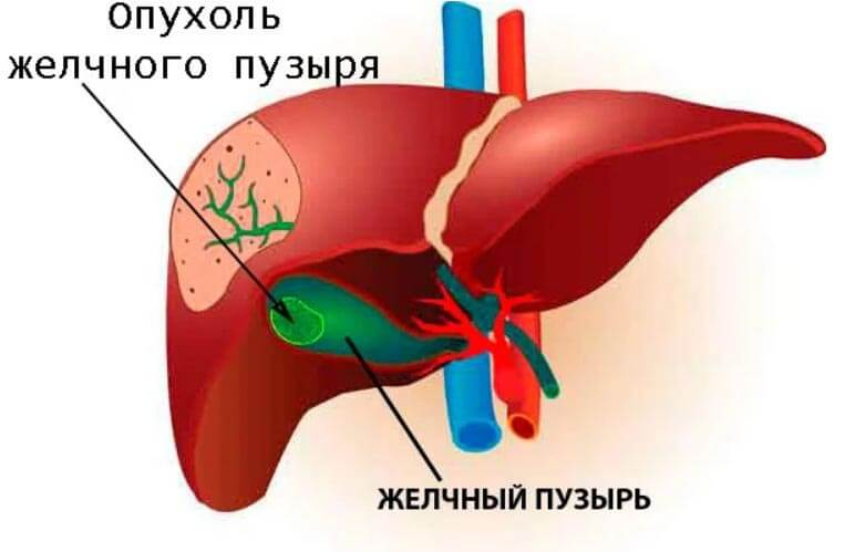 Отекает желчный пузырь