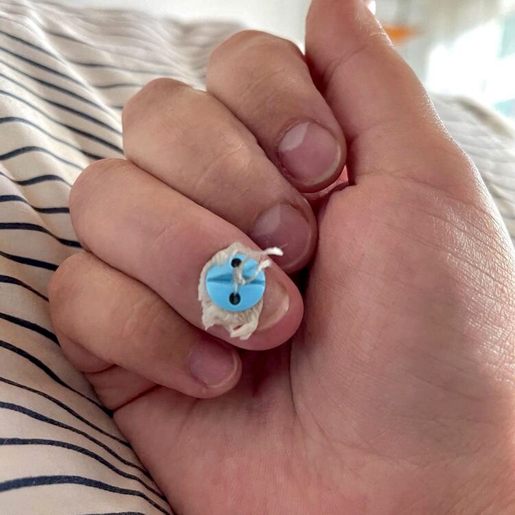 Источник: https://www.reddit.com/r/mildlyinteresting/comments/135x1vc/i_had_a_tendon_transplant_in_my_finger_and_theyre