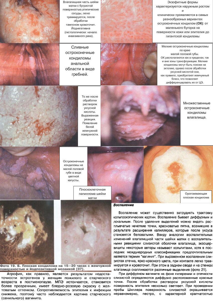 Кондиломы во влагалище у женщины